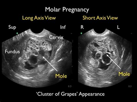 Molar Pregnancy Diagnosis Of Hydatidiform Mole Using Bedside Emergency