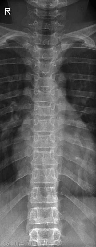Ap Thoracic Spine Breathing Technique Wikiradiography