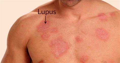 What Do Lupus Rashes Look Like Sexiezpicz Web Porn