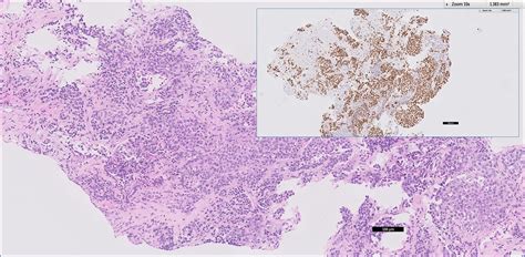 Cureus Rare Metastatic Sites Of A Lung Adenocarcinoma