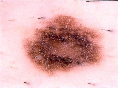 Dysplastic Nevus Skin Cancer Or Mole How To Tell Pictures Cbs News