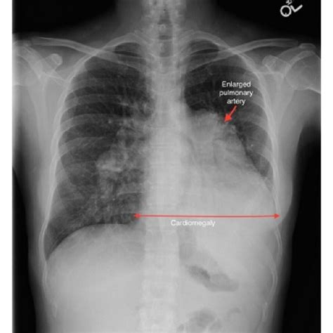 A Chest Radiograph Shows A Markedly Enlarged Pulmonary Trunk Red