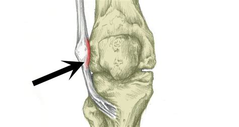 Iliotibial Band Syndrome Knee Pain