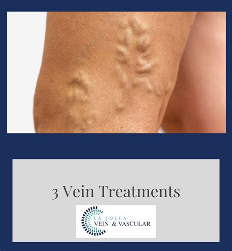 Veincenter Archives La Jolla Vein And Vascular Accredited Vein Center