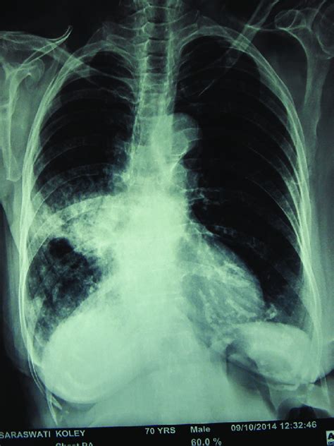 Chest X Ray Posteroanterior View Showing Areas Of Consolidation In
