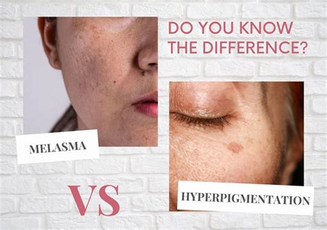 Hyperpigmentation Vs Melasma Eeva Medical Clinic