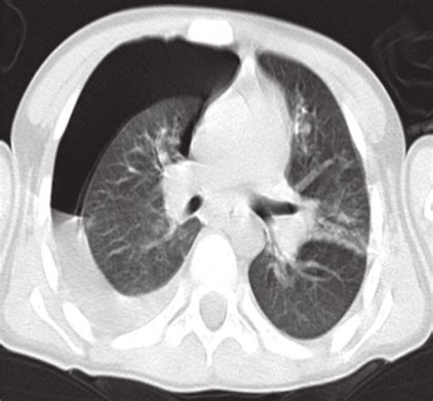 Thoracal Ct Image Showing Pleural Effusion And Pneumothorax Anterior Download Scientific