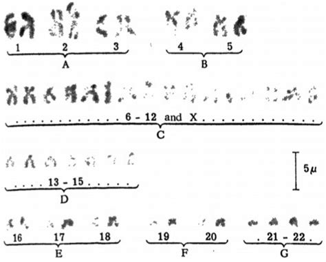 Patau Syndrome Chromosomes