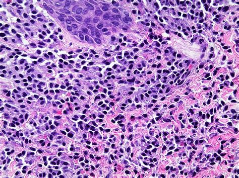 Pathology Outlines Mastocytosis Of Skin