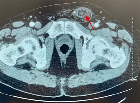 Cureus A Rare Case Of Incarcerated Inguinal Hernia Containing Fat And