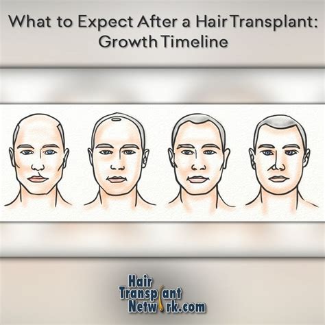Hair Transplant Growth Chart