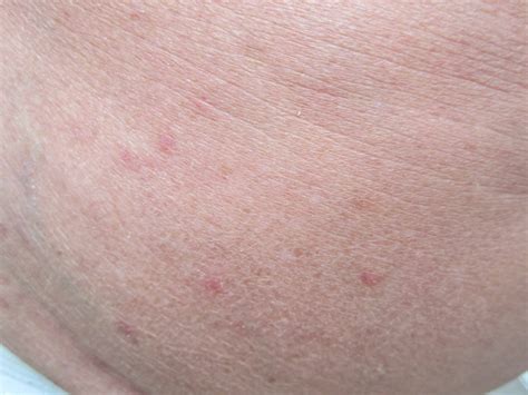 I Suffer From Lichen Planus And Have Done For Two Years After