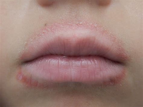 Red Bumps On Lips Treatment