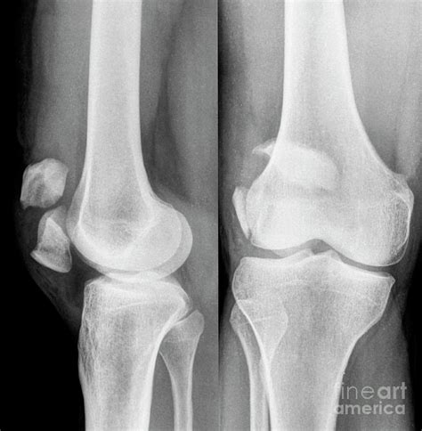 Kneecap Fracture Photograph By Rajaaisyascience Photo Library Fine