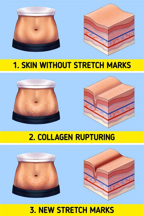 A Simple Definition Of Stretch Marks And How To Get Rid Of Them