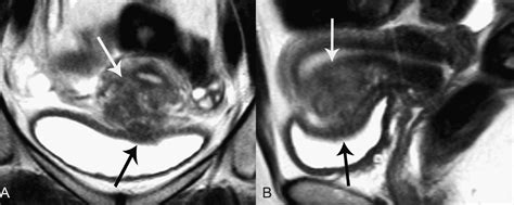 Mr Imaging Of Bladder Endometriosis And Its Relationship With The