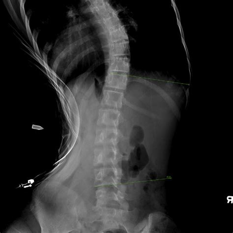 Pre Operative Standing Posteroanterior X Ray Of The Whole Spine Which
