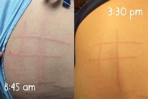 16 Photos That Show What Dermatographism Looks Like
