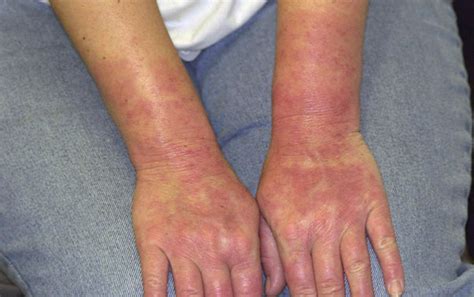 Latex Allergy Symptoms Causes Diagnosis And Treatment Natural