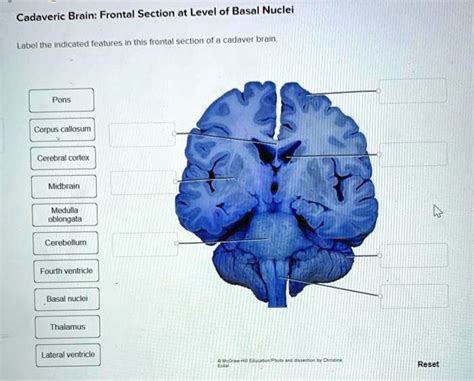 Solved Cadaveric Brain Frontal Section At Level Of Basal Nuclei Label
