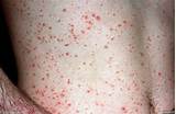 Photos of Guttate Psoriasis Mayo Clinic
