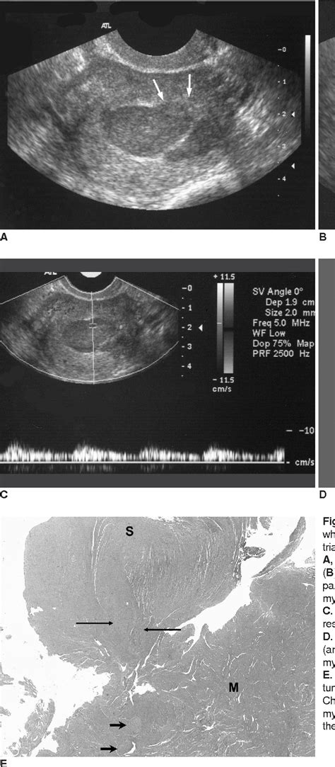 Figure 2 From Sonographic Findings Of Uterine Endometrial Stromal