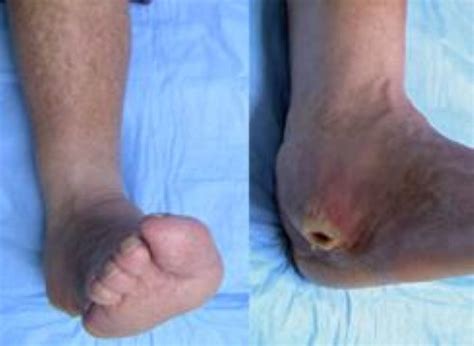 Diabetic Charcot Foot Orthoinfo Aaos
