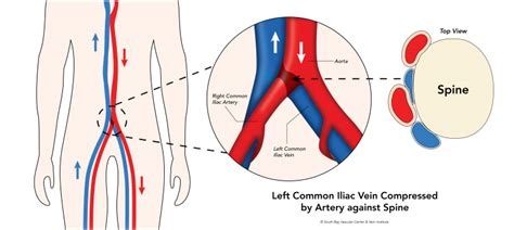 Leg Swelling South Bay Vascular Center And Vein Institute