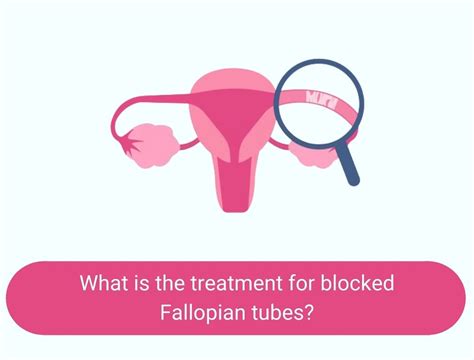 What Is The Treatment For Blocked Fallopian Tubes Flickr