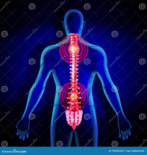 X Ray Of The Spine Inflammation In The Human Spine Stock Vector