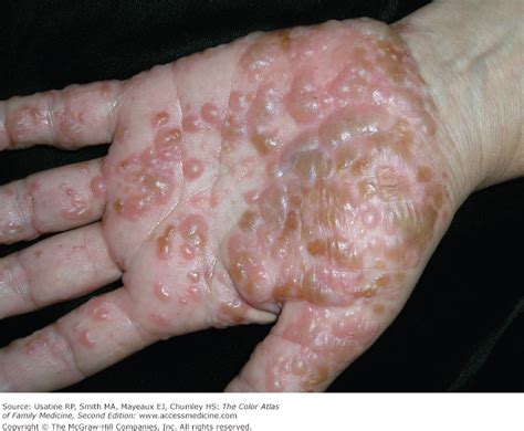 The fluid will be reabsorbed, and the skin will reintegrate the palm. Pompholyx Eczema | Natural Healing - EczemaHealing.org