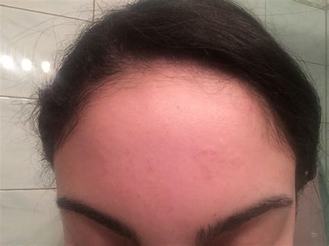 Raised Bumps On Forehead Porn Sex Picture Hot Sex Picture