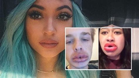New ‘kylie Jenner Challenge Sees Teens Trying To Get Bigger Lips Al