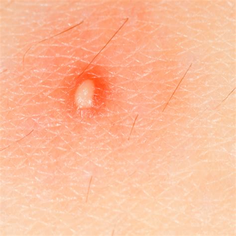 Common Skin Conditions White Rock Dermatology Skin Treatments Tx