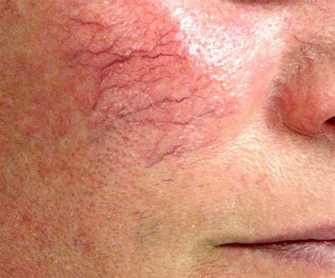 Facial Vein And Redness Treatments