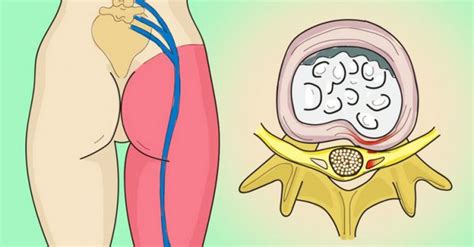 How To Release The Pinched Nerve In The Lumbar Area Sciatica 5
