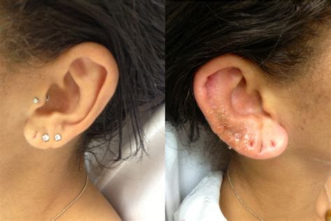 Complications Of Ear Piercing Perichondritis And Ear Disfigurement