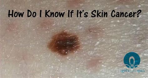 Beauty Marks Moles Or Skin Cancer A Girls Gotta Spa