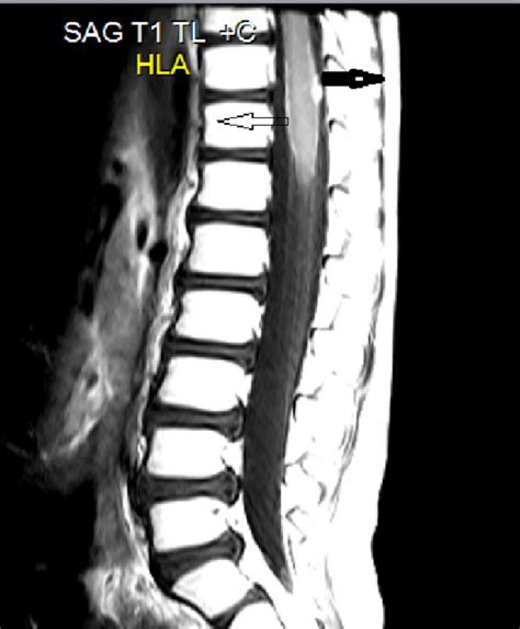 Sagittal T1 Weighted Post Contrast Mri Of The Thoracic Spine