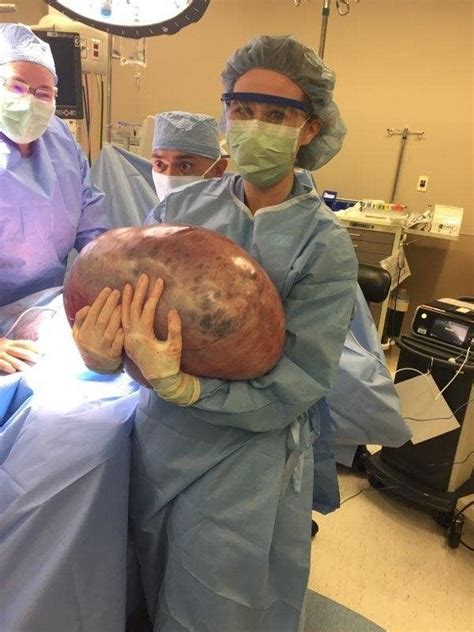 A Woman With A 50 Pound Ovarian Cyst Was Initially Told To Just Lose Weight