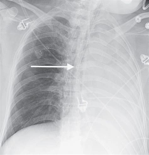 Atelectasis Chest X Ray