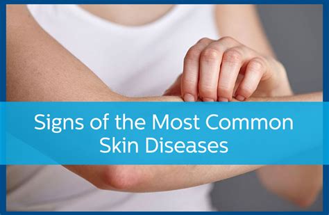 Signs Of The Most Common Skin Diseases Avail Dermatology
