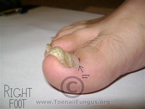 Toenail Fungus Pictures Added By Viewers Toenail Fungus