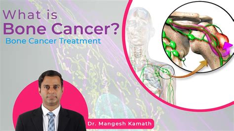 What Is Bone Cancer Bone Cancer Treatment Bone Marrow Transplant