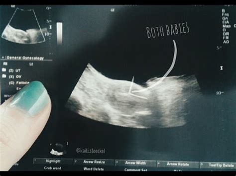 Die einnistung ist nach der befruchtung eine wesentliche voraussetzung für eine schwangerschaft. IVF w/ ICSI | Transfer Update & Testing?! | TTC: Baby #1 ...