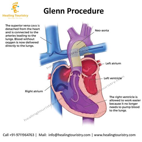 Pin On Glenn Procedure