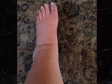Jessica Simpsons Foot Swells Like A Balloon During Pregnancy Help
