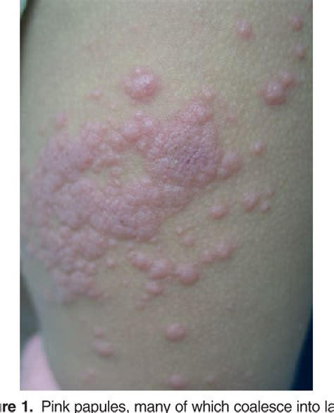 Figure 1 From Gianotti Crosti Syndrome After Childhood Vaccination
