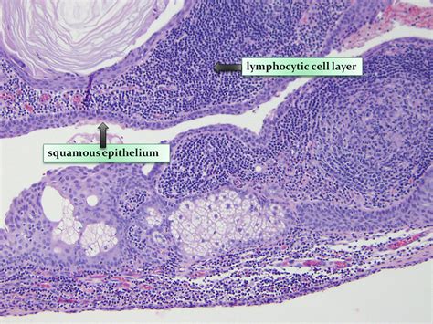 Pancreatic Lymphoepithelial Cyst Videogie