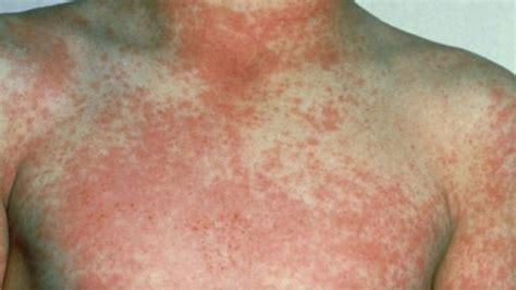 Scarlet Fever Is Making A Comeback Here Are The Warning Signs Every